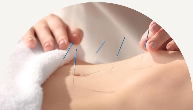 Acupuncture